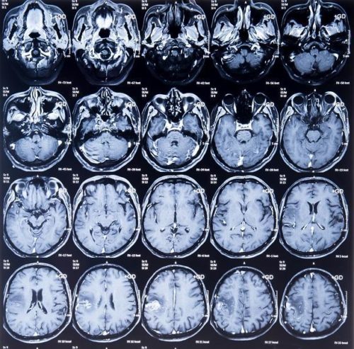 MRI images of the brain