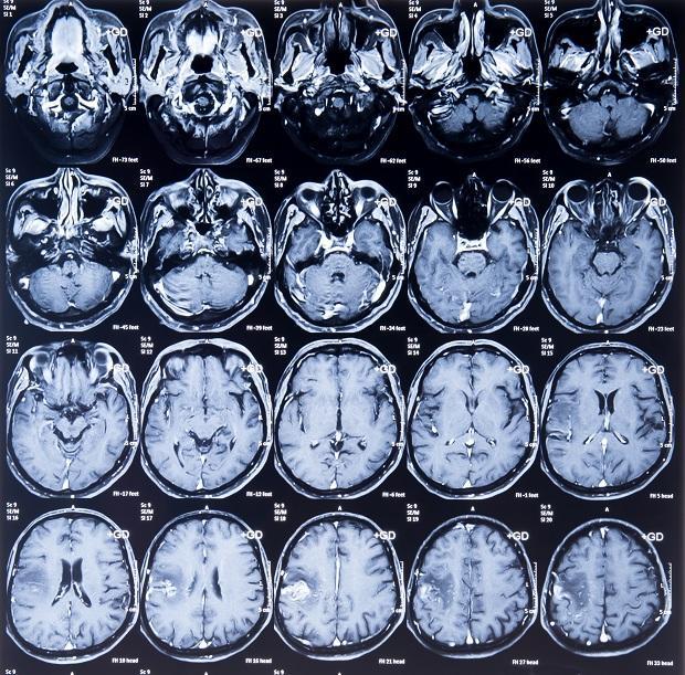 MRI scan - Lymphoma Australia