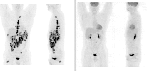 PET scans highlight areas of lymphoma in black