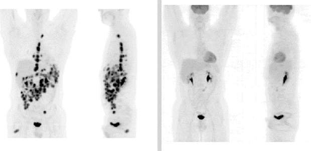 Pet Scan Lymphoma Australia