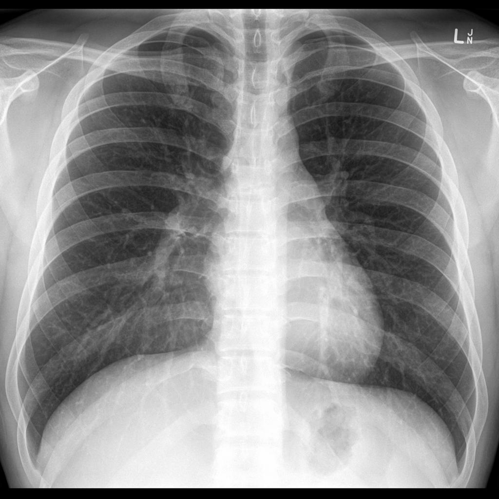 x rays lymphoma australia what is maintenance engineering how to do covid 19 risk assessment