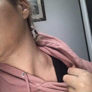 Swollen lymph node in Hodgkin Lymphoma Swollen lymph node in Hodgkin Lymphoma