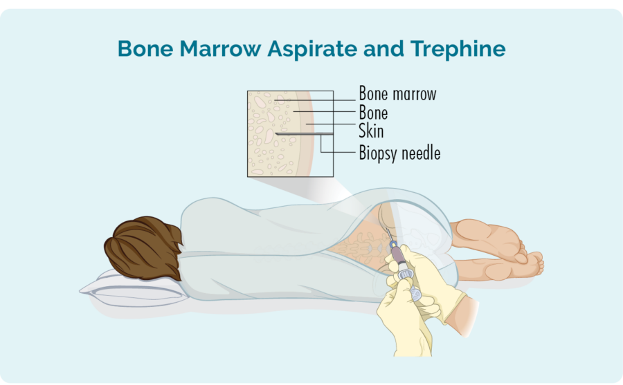 Bone marrow biopsy siv cov qauv ntawm koj cov pob txha pob txha los ntawm koj cov pob txha pob txha