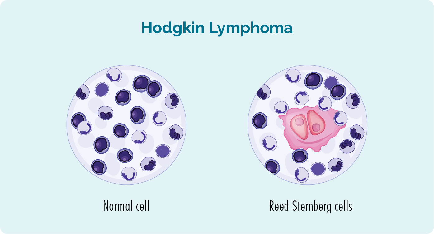 Reed-Sternberg cells help diagnose HL, they are not present in non-hodgkin lymphomas