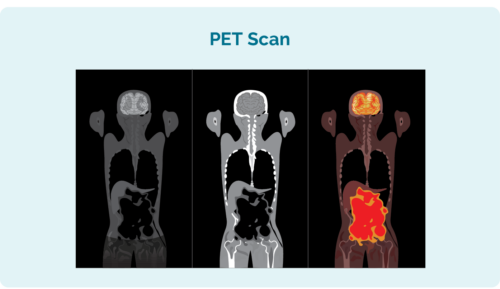 PET scan - Whole body scan that lights up areas affected by Hodgkin lymphoma helps with diagnosis and staging