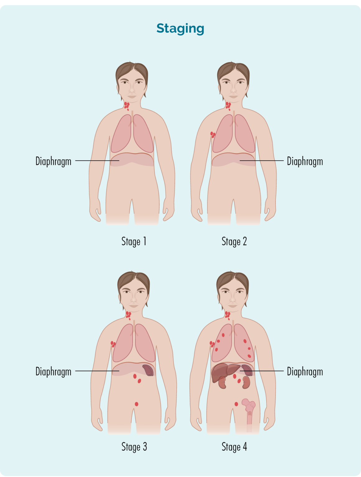 Hodgkin Lymphoma Lymphoma Australia