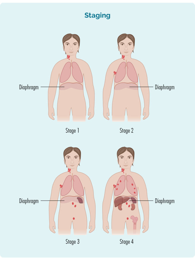 Staging lymfómu