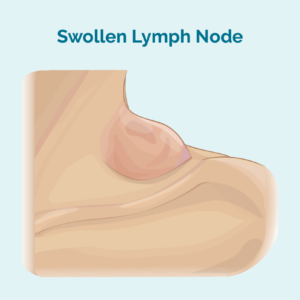 Swollen lymph node Swollen lymph node