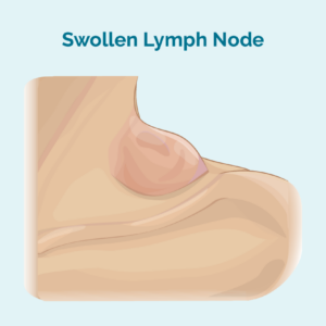 Geschwollener Lymphknoten