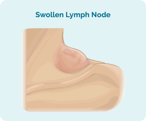 Swollen lymph node in Hodgkin Lymphoma Swollen lymph node in Hodgkin Lymphoma