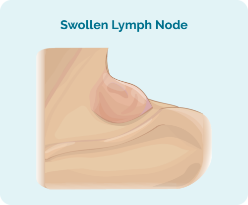 Swollen lymph node in Hodgkin Lymphoma