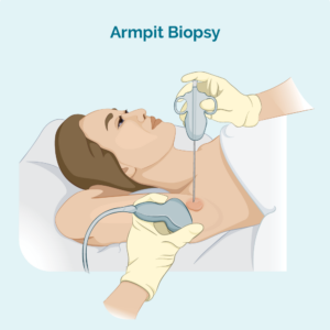 Fine needle biopsy of swollen lymph node Biopsy of Swollen Lymph node to test for CLL or SLL