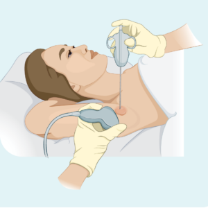 Fine needle biopsy of swollen lymph node Biopsy of Swollen Lymph node to diagnose for Hodgkin Lymphoma