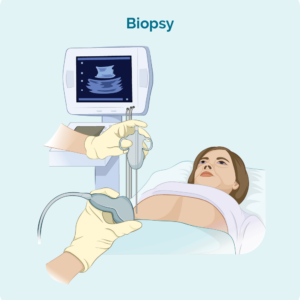 Ultrasound guided biopsy of swollen lymph node