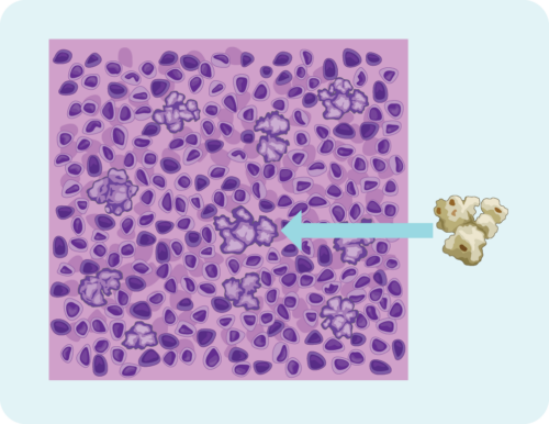 A popcorn looking cell with the protein CD20 lets your doctor you have Nodular lymphocyte predominant Hodgkin lymphoma