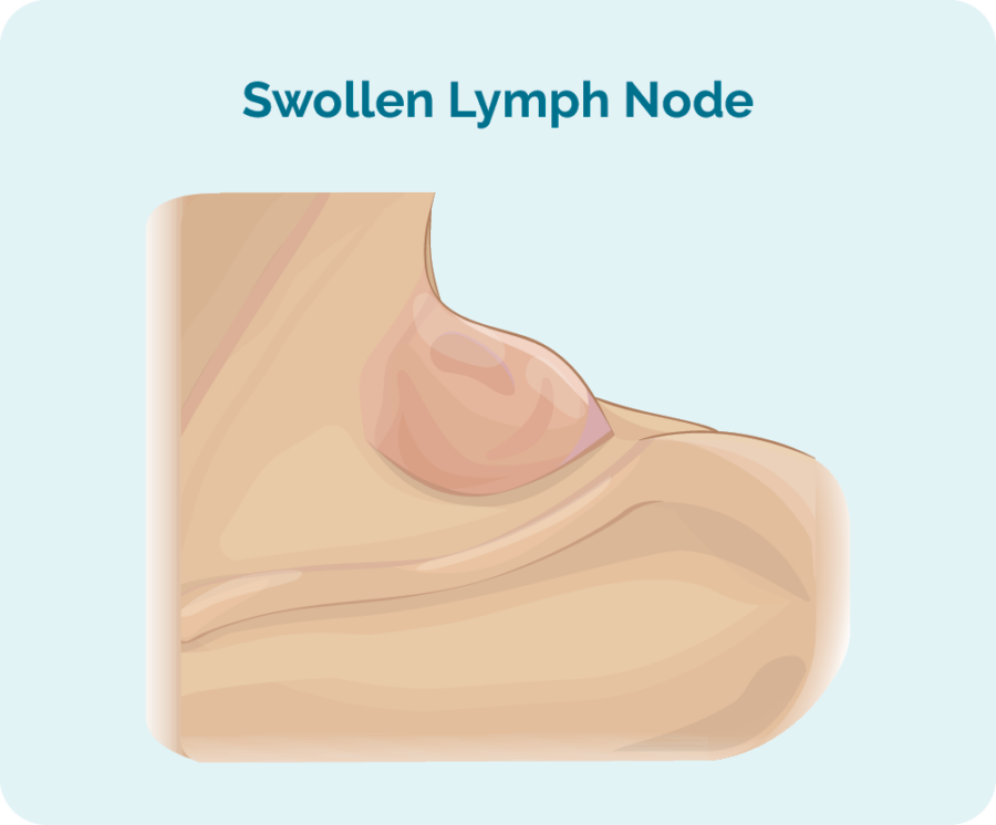 A swollen lymph node is often the first symptom of lymphoma. This is shown as lump on the neck, but can also be in the armpit, groin or anywhere else in the body.