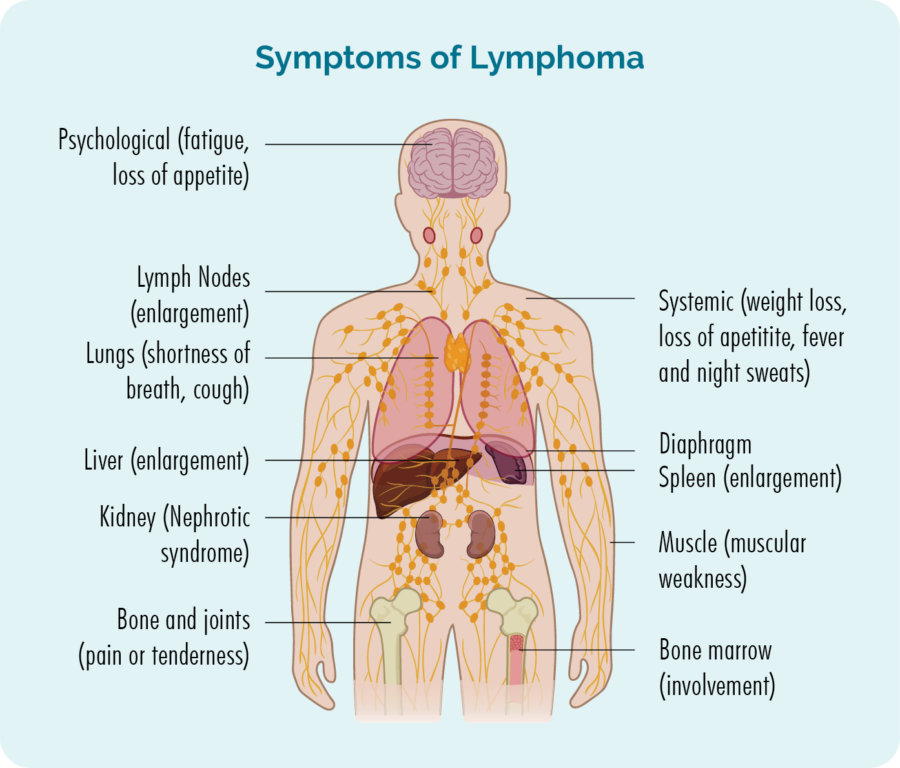 Symptoms of lymphoma can include fatigue, loss of appetite, weight loss, fevers and chills, shortness of breath or a cough, swollen lymph nodes, lever or spleen, pain or tenderness in your joints and muscles and in some cases, lower blood counts or kidney problems.