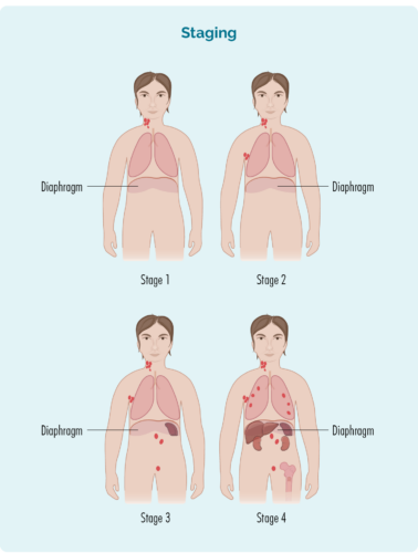 Staging of lymphoma is shown as stage one affecting only one group of lymph nodes, stage two affecting two groups of lymph nodes but all on the same side of the diaphragm, stage 3 affects lymph nodes both above and below the diaphragm and stage 4 with lymph nodes above and bleow the diaphragm as well as in at least one organ such as the liver, lungs or bone marrow.