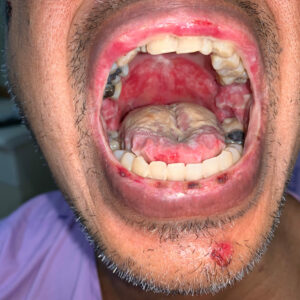 Image of Asian man with open moth mouth showing severe mucositis seen as white-yellowing coasting on tongue with sores on his tongue, lips and chin. He is wearing a purple hospital gown.