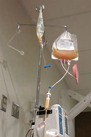 Image of yellowish coloured platelets haning on an IV pole to be transfused.