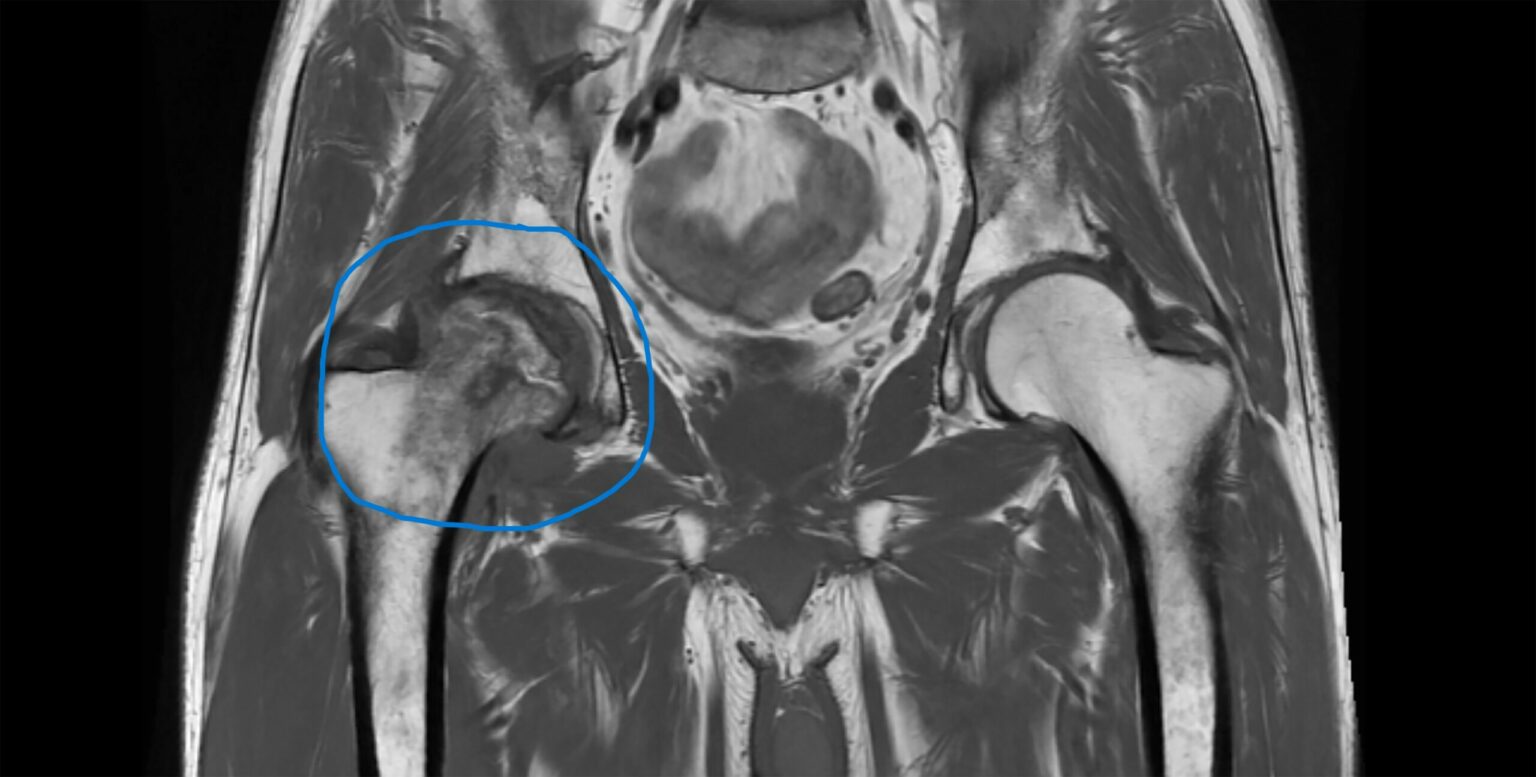 Avascular Necrosis (AVN) - Lymphoma Australia