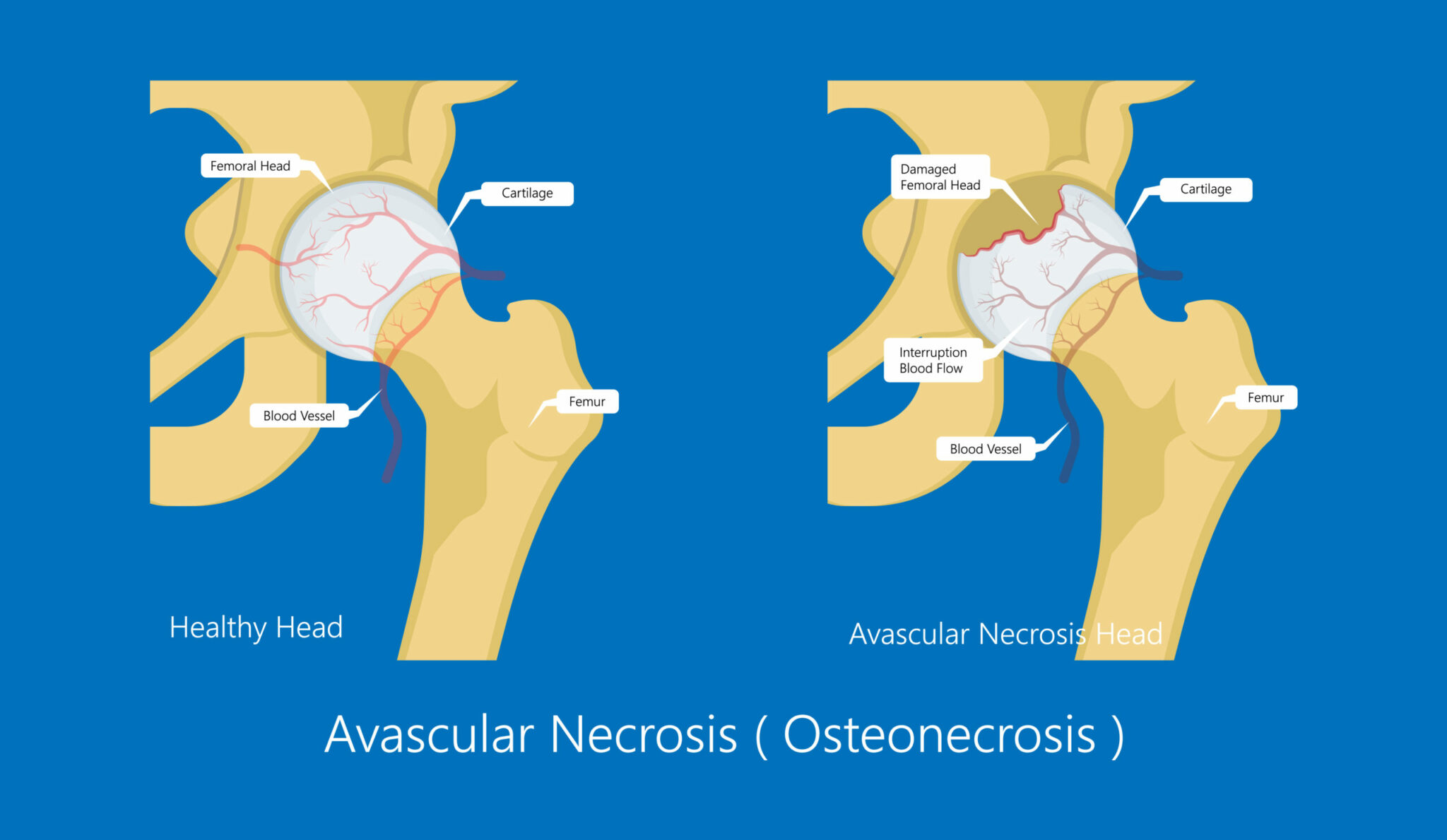 avascular-necrosis-avn-lymphoma-australia